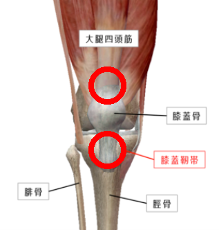 膝蓋靭帯炎のイメージ